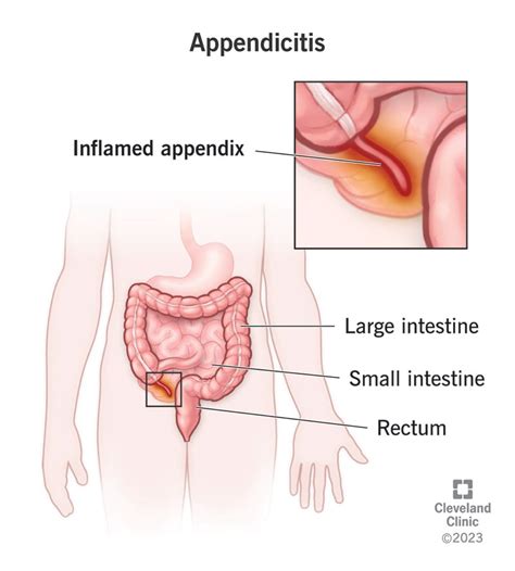 understanding appendicitis symptoms  treatment   nurse expert