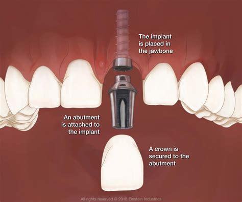 dental implants   front teeth brooklyn heights ny