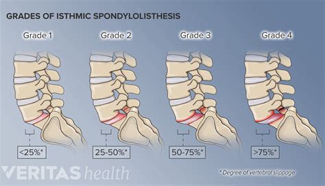 lumbosacral joint spine health