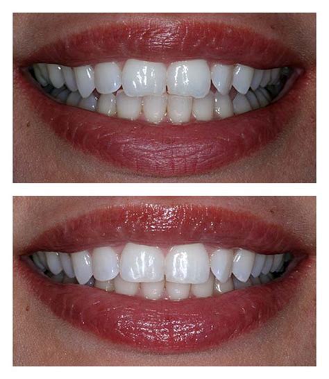 Tooth Contouring Before And After Bartholomew Dentist