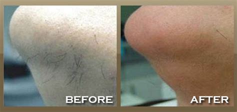 laser hair removal brentwood west hollywood la skineccable