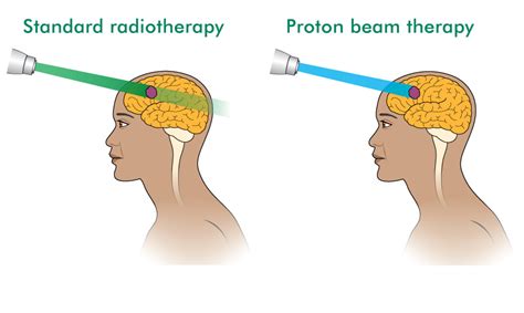 proton beam therapy macmillan cancer support
