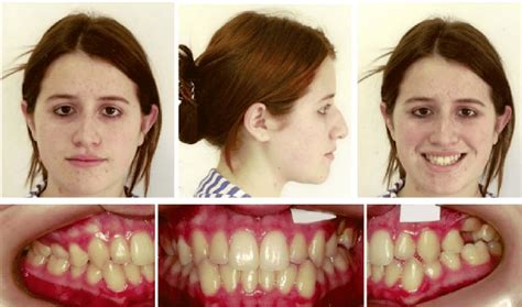 extraoral  intraoral pretreatment photographs  scientific