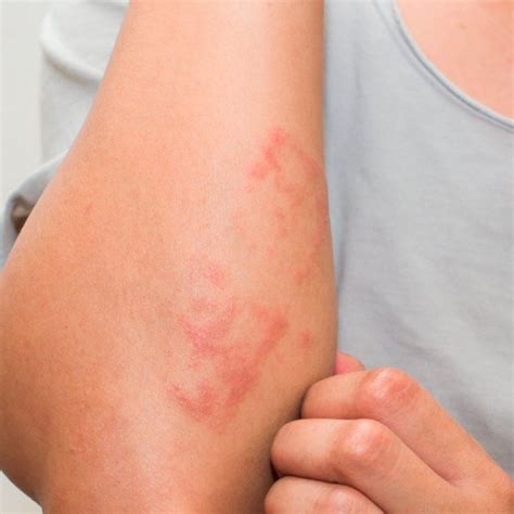 contact dermatitis  natural treatments dr axe skin allergies contact dermatitis