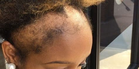 this woman s honesty about her hair loss will make you think twice