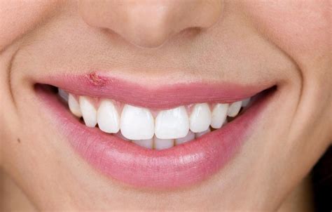 cold sores home remedies   treatment