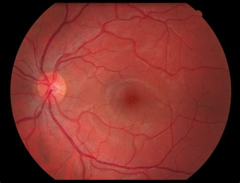 retina retinal detachment   retinal issues