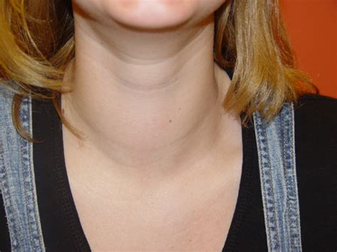 homeoallhomeopathy treatment thyroid goiter hypothyroidism hyperthyroidism