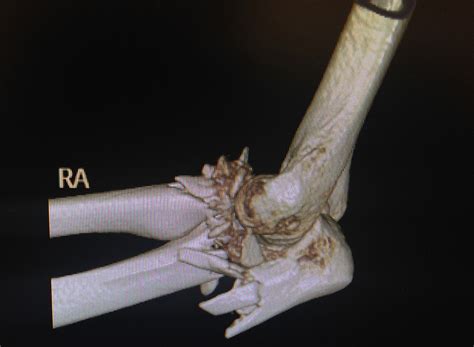 elbow fracture surgery hertfordshire olecranon fracture middlesex