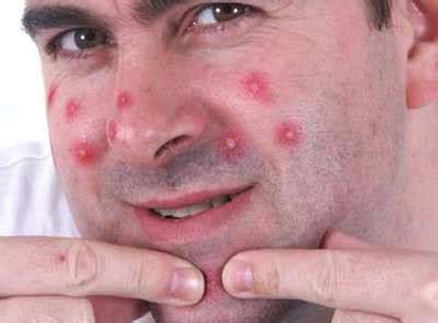 learn    rid  pimples medicalstopcom