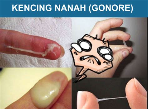 symptoms of gonorrhea in men and how to recognize gonorrhea gpled corp