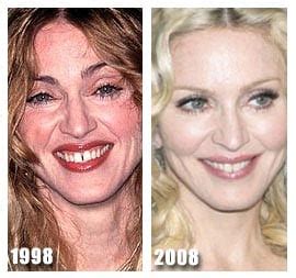celebrity madonna plastic surgery    celeb surgerycom