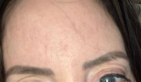 Forehead Acne Scars Scar Treatments