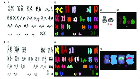Novel Chromosomal Aberrations Identified In Cml Ap Patients A I