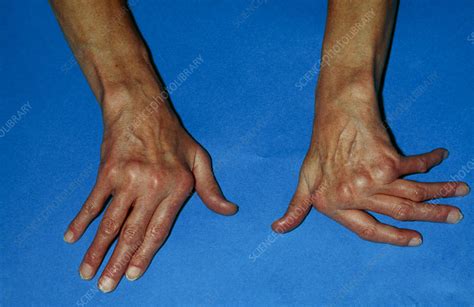 rheumatoid arthritis  hand stock image  science photo