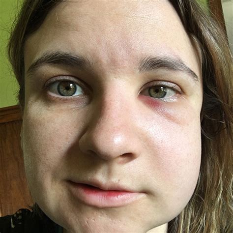 facial swelling after wisdom teeth removal porn pics