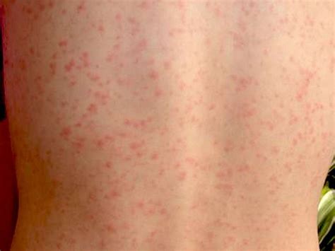 Viral Infection Rash Adults Gue Viral