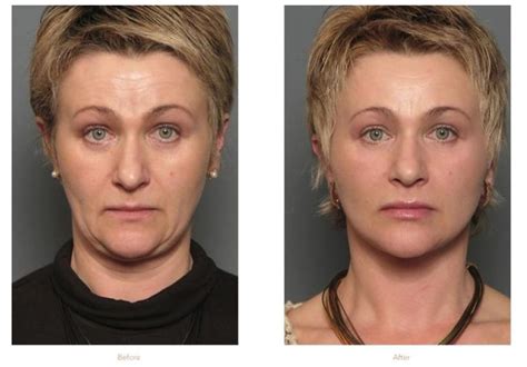how can i lift sagging jowls stein plastic surgery