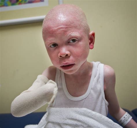 albino children maimed  tanzania  healing