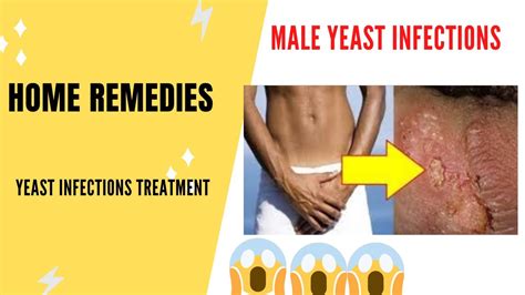Male Yeast Infection Home Remedies For Yeast Infection Home