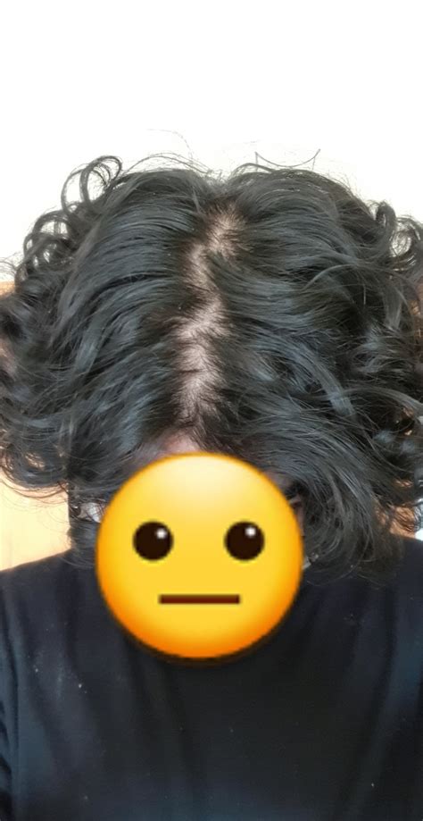 scalp  showing   middle part im      middle part
