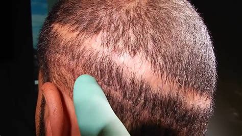 bad hair transplants leave  bad scar top hair transplant surgeons