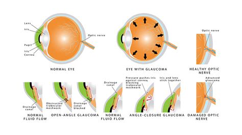 Glaucoma Treatment Iristech