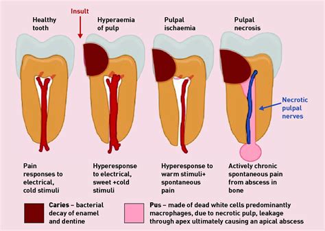 tooth pain  injury