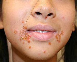 rid  impetigo treatment options everyday health vlrengbr