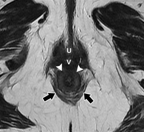 mr imaging based assessment of the female pelvic floor radiographics