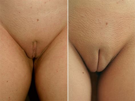 circumcision of the clitoris xxx pics