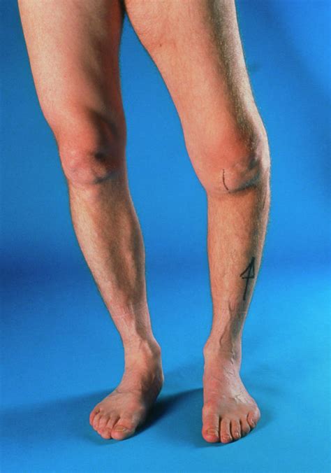 severe osteoarthritis   left knee photograph  medical photo nhs