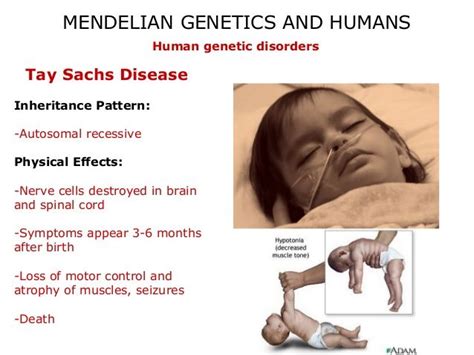 Tay Sachs Disease Patient Disease Genetic Disorders Nerve Cell