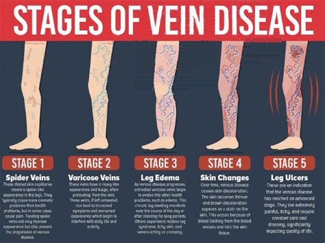 venous disease     varicose veins southwest floridas
