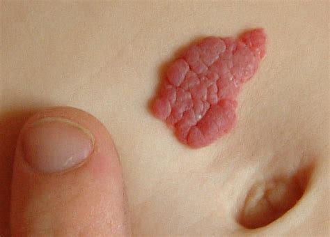 healthool strawberry hemangioma pictures symptoms