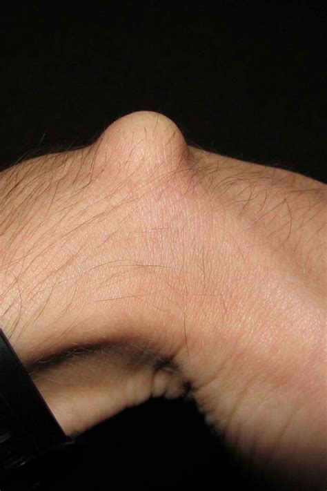 ganglion cyst symptoms   treatment