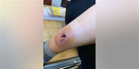 Mom Claims Spider Bite Left Son With Gaping Hole In Leg