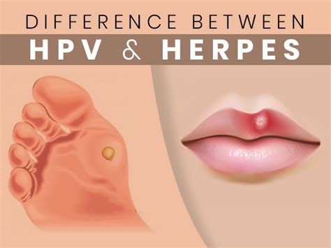 What Is The Difference Between Hpv And Herpes