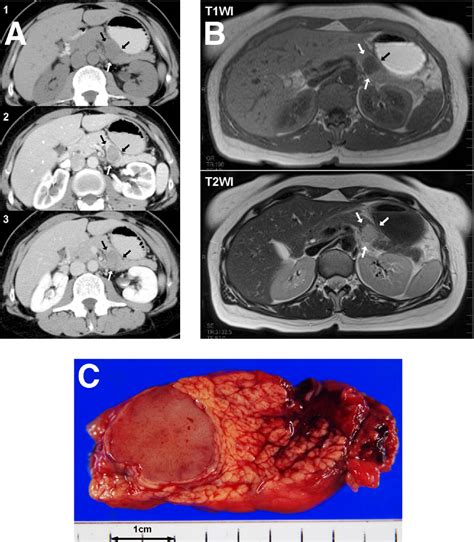 Solid Pseudopapillary Tumor Of The Pancreas Without A Cystic Component