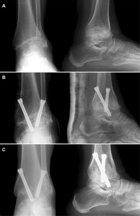 arthroscopic arthrodesis  ankle arthritis  bone graft
