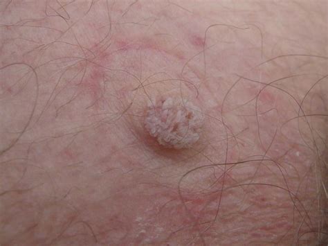Warts On The Inner Thigh Warts On The Inner Thigh