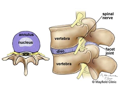 easy health options surgery     option   herniated disc