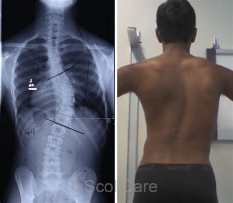 Reduction Of Severe Scoliosis In A 14 Year Old Male Patient