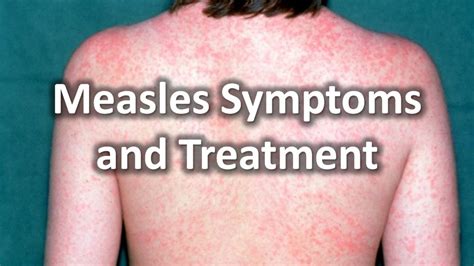 adult symptoms of measles sex positive