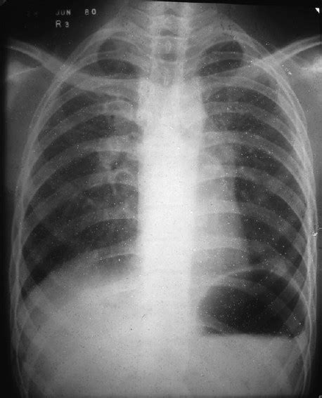 Chest X Ray 1980 Showing Bilateral Hilar And Left Par Open I