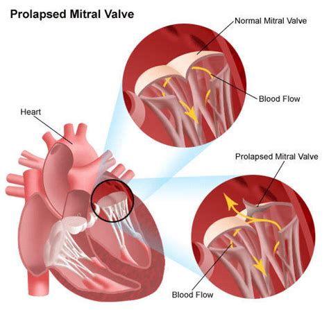 Fatality And Mortality Risk Mitral Valve Prolapse