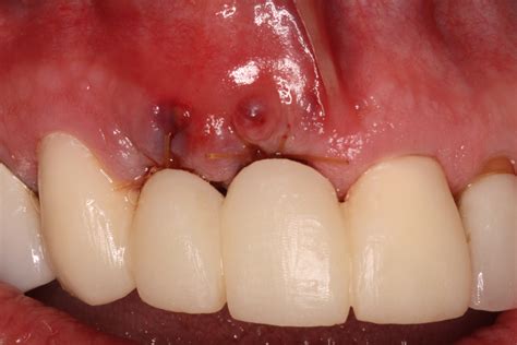 front view bone graft dental implants ryan lanman dds msd