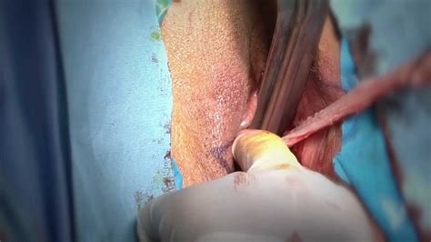 vaginoplasty vaginal surgery youtube