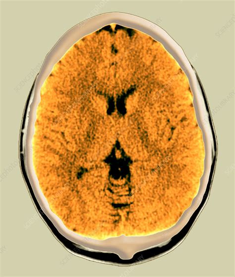 Healthy Brain Ct Scan Stock Image P332 0390 Science