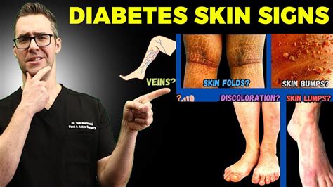 top  diabetes skin signs symptoms type   diabetes mellitus diabetes